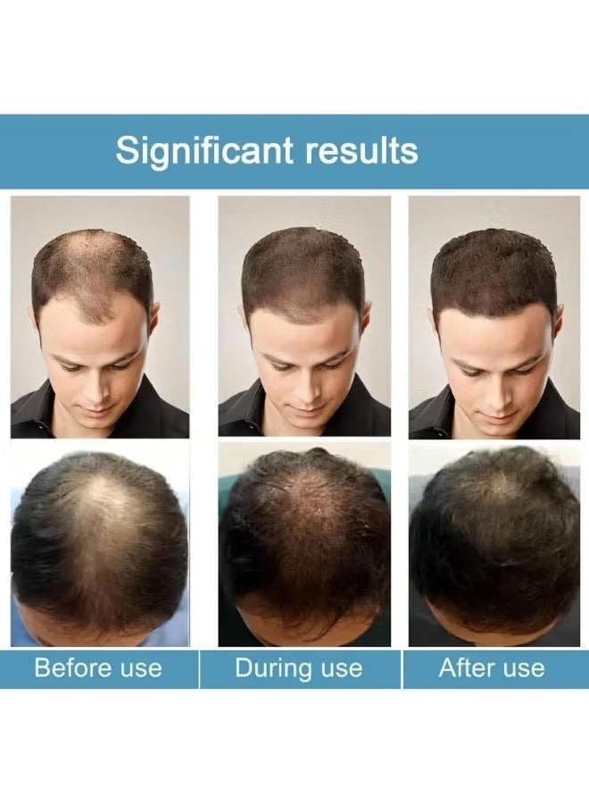 وينز تاون مجموعة محلول تكثيف الشعر بالإبر الدقيقة 30 مل | شعر أكثر كثافة، يقوي الجذور، لطيف وغير مؤلم، يدعم نمو الشعر الصحي للرجال والنساء (6 زجاجات من السيروم + 2 بكرات إبر دقيقة) - Image 4